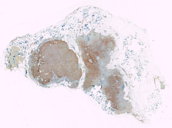 1C1 Meningioma, lymphoplasmacytic (Case 1) A3 EMA WM a