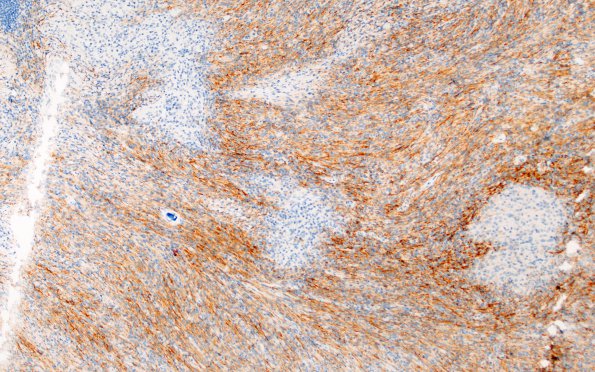 1C2 Meningioma, lymphoplasmacytic (Case 1) A3 EMA 10X