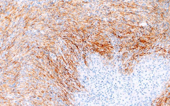 1C3 Meningioma, lymphoplasmacytic (Case 1) A3 EMA 20X 2