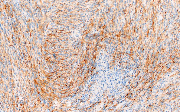 1C4 Meningioma, lymphoplasmacytic (Case 1) A3 EMA 20X 3