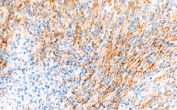 1C5 Meningioma, lymphoplasmacytic (Case 1) A3 EMA 40X 2