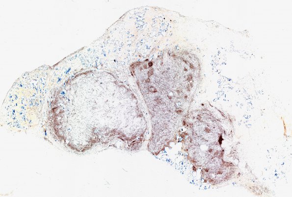 1E1 Meningioma, lymphoplasmacytic (Case 1) A3 CD3 WM