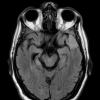 2A1 Meningioma, Lymphoplasmacyte-rich (Case 2) FLAIR - Copy