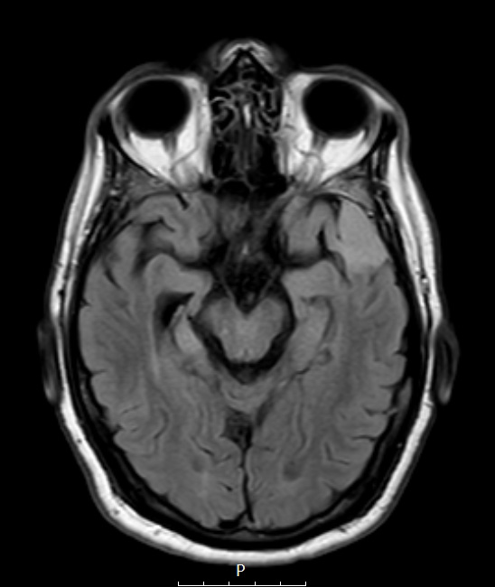 2A1 Meningioma, Lymphoplasmacyte-rich (Case 2) FLAIR - Copy