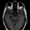 2A2 Meningioma, Lymphoplasmacyte-rich (Case 2) T1noC - Copy