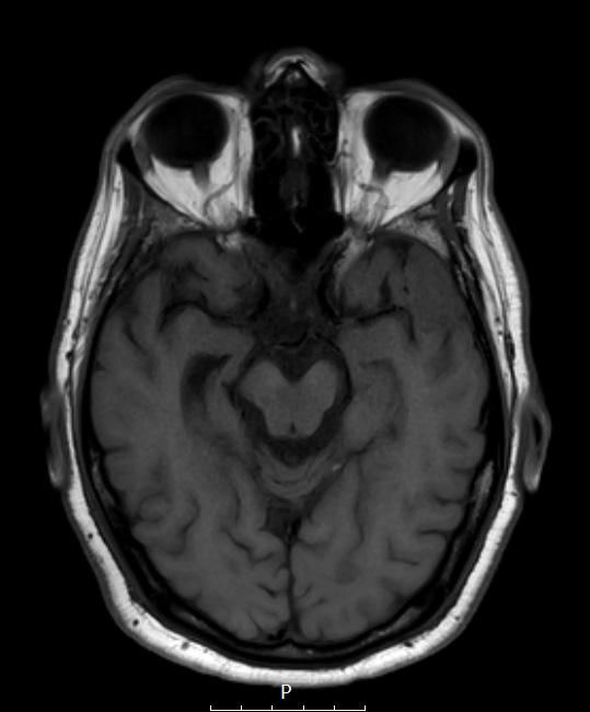 2A2 Meningioma, Lymphoplasmacyte-rich (Case 2) T1noC - Copy