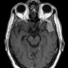 2A3 Meningioma, Lymphoplasmacyte-rich (Case 2) T1W - Copy