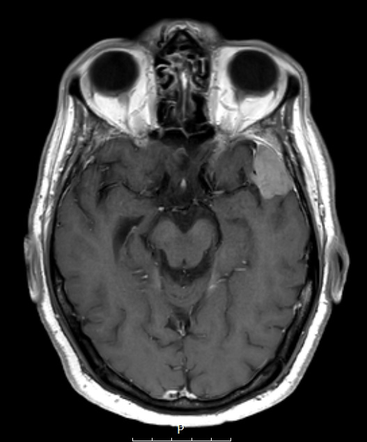 2A3 Meningioma, Lymphoplasmacyte-rich (Case 2) T1W - Copy