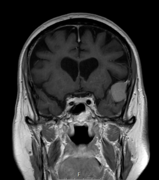 2A4 Meningioma, Lymphoplasmacyte-rich (Case 2) T1W Coronal - Copy