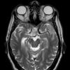 2A5 Meningioma, Lymphoplasmacyte-rich (Case 2) T2noC - Copy