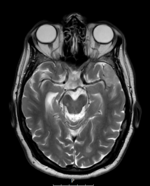 2A5 Meningioma, Lymphoplasmacyte-rich (Case 2) T2noC - Copy