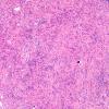 2B1 Meningioma, Lymphoplasmacyte-rich (Case 2) H&E 10X 2