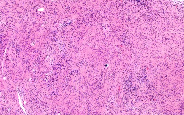 2B1 Meningioma, Lymphoplasmacyte-rich (Case 2) H&E 10X 2