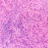 2B2 Meningioma, Lymphoplasmacyte-rich (Case 2) H&E 20X 3