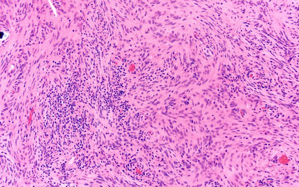 2B2 Meningioma, Lymphoplasmacyte-rich (Case 2) H&E 20X 3