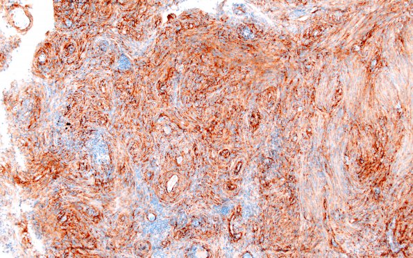 2C1 Meningioma, Lymphoplasmacyte-rich (Case 2) EMA 10X 1