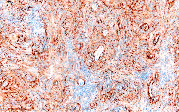 2C2 Meningioma, Lymphoplasmacyte-rich (Case 2) EMA 20X 1