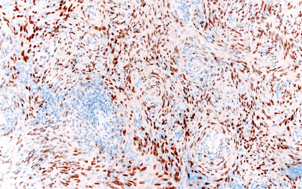 2D2 Meningioma, Lymphoplasmacyte-rich (Case 2) PR 20X 1