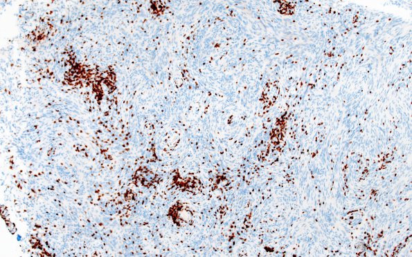 2E2 Meningioma, Lymphoplasmacyte-rich (Case 2) CD3 10X 2