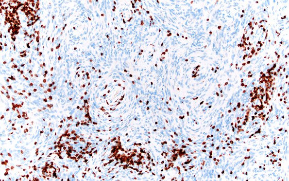 2E3 Meningioma, Lymphoplasmacyte-rich (Case 2) CD3 20X 2