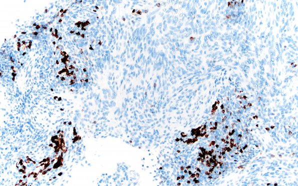 2F Meningioma, Lymphoplasmacyte-rich (Case 2) CD20 20X