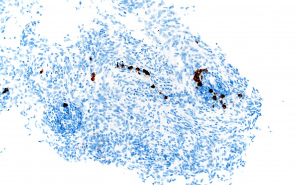 2G Meningioma, Lymphoplasmacyte-rich (Case 2) CD138 20X