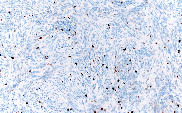 2H Meningioma, Lymphoplasmacyte-rich (Case 2) Ki67 20X