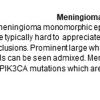 0A Meningioma - Meningothelial - Text