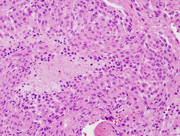 10A1 Meningioma (Case 10) H&E 2