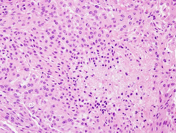 10A2 Meningioma (Case 10) H&E 3