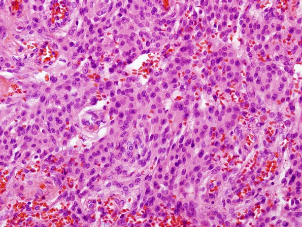 11A Meningioma (Case 11) H&E 1