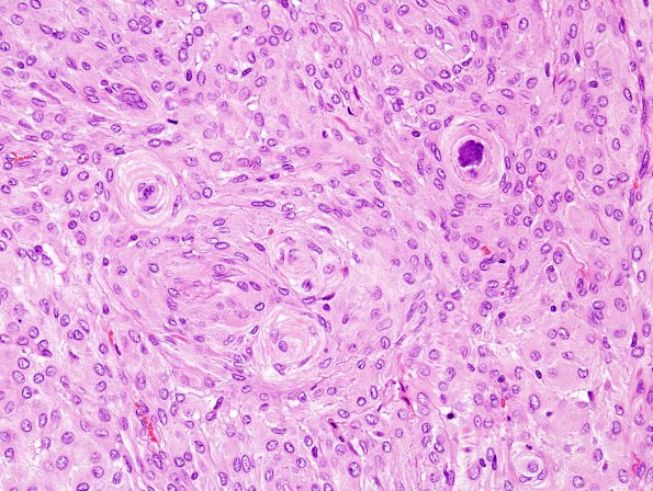 12 Meningioma (Case 12) H&E 5