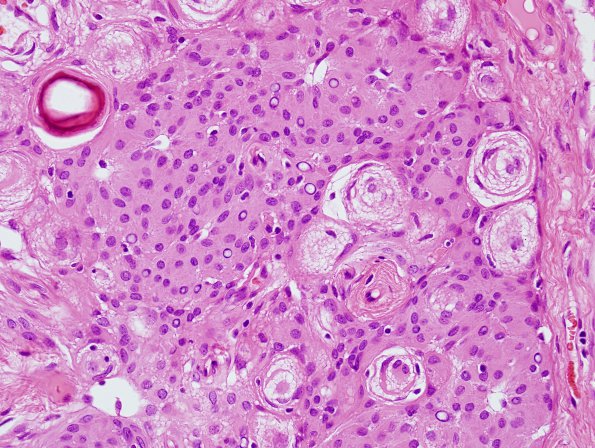 13 Meningioma (Case 13) H&E 11