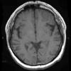 14A1 Meningioma (Case 14) T1 1 - Copy