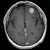 14A2 Meningioma (Case 14) T1 W 1 - Copy