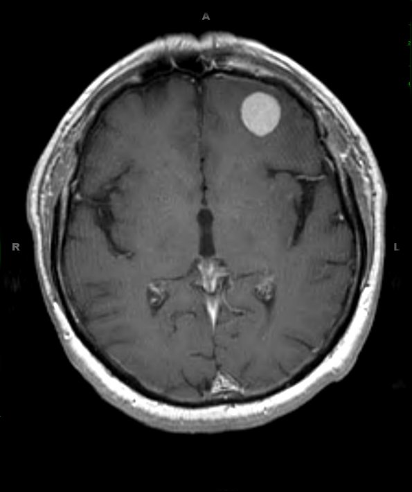 14A2 Meningioma (Case 14) T1 W 1 - Copy