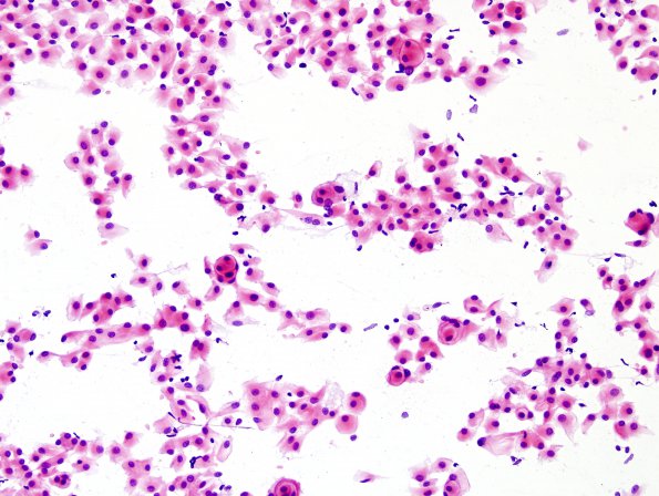 14B1 Meningioma (Case 14) Smear H&E 3