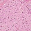 14B2 Meningioma (Case 14) H&E 1 - Copy