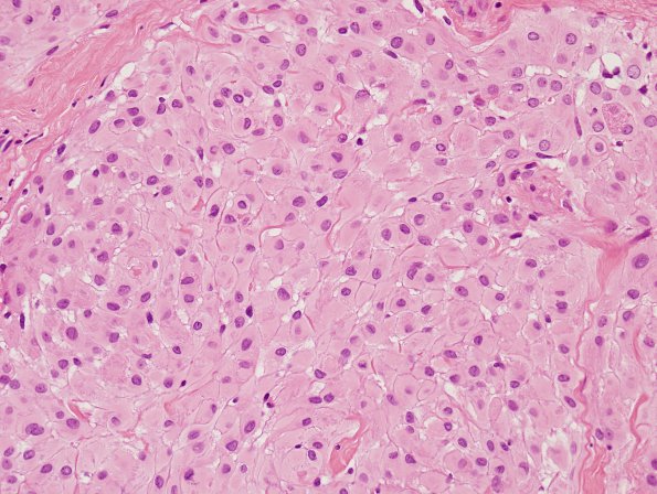 14B2 Meningioma (Case 14) H&E 1 - Copy