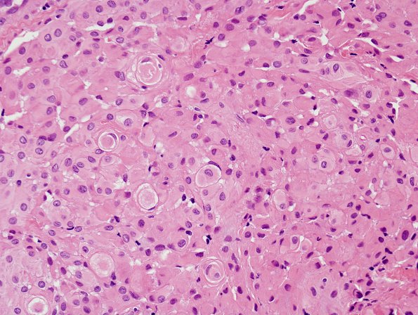 14B3 Meningioma (Case 14) H&E 2 - Copy