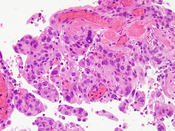 15 Meningioma (Case15) H&E 1