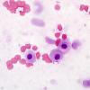 16A1 Meningioma w mast cell aggregates (Case 16) H&E smear 100X 2.jpg