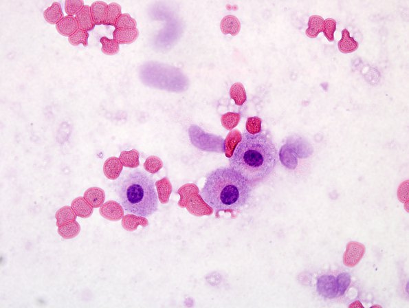 16A1 Meningioma w mast cell aggregates (Case 16) H&E smear 100X 2.jpg