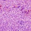 16A2 Meningioma w mast cell aggregates (Case 16) H&E 1.jpg