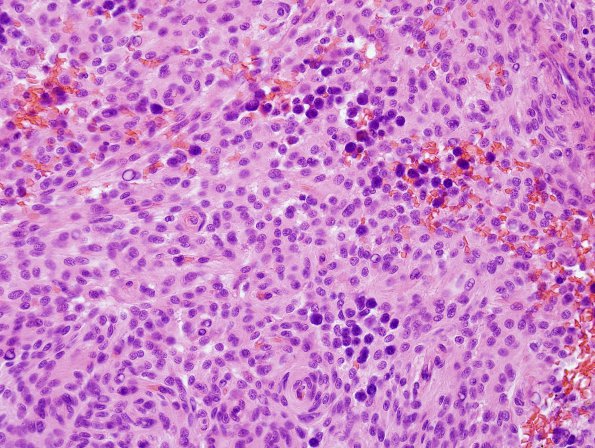 16A2 Meningioma w mast cell aggregates (Case 16) H&E 1.jpg