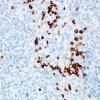 16B Meningioma w mast cell aggregates (Case 16) c-kit 1.jpg