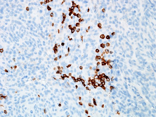 16B Meningioma w mast cell aggregates (Case 16) c-kit 1.jpg