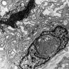 17A2 Meningioma (Case 17) EM 4 - Copy