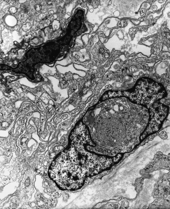 17A2 Meningioma (Case 17) EM 4 - Copy