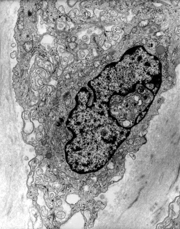 17A3 Meningioma (Case 17) EM 5 - Copy